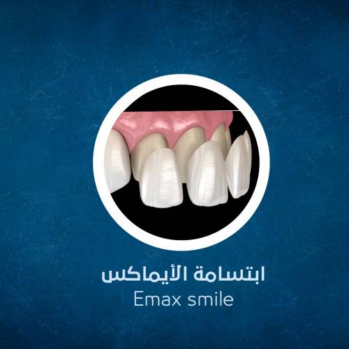 Emax Smile