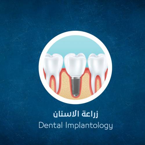 Dental implants