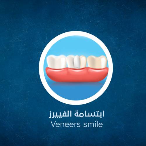 Veneers smile